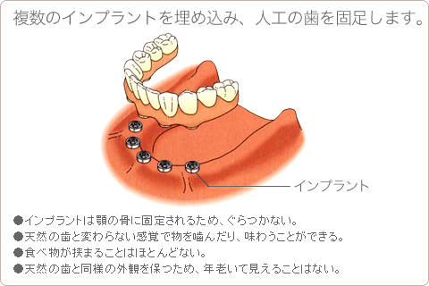 複数のインプラントを埋め込み、人工の歯を固足します。